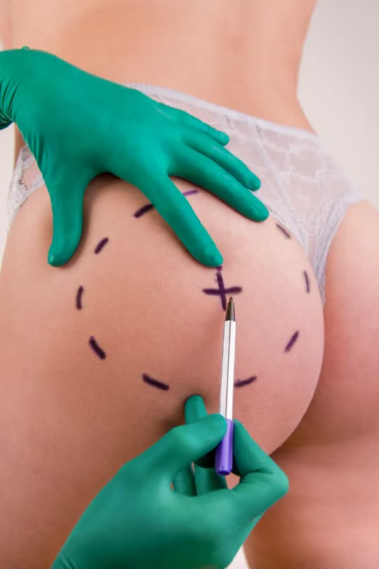 Imagen clínica de la zona de los glúteos durante una evaluación.